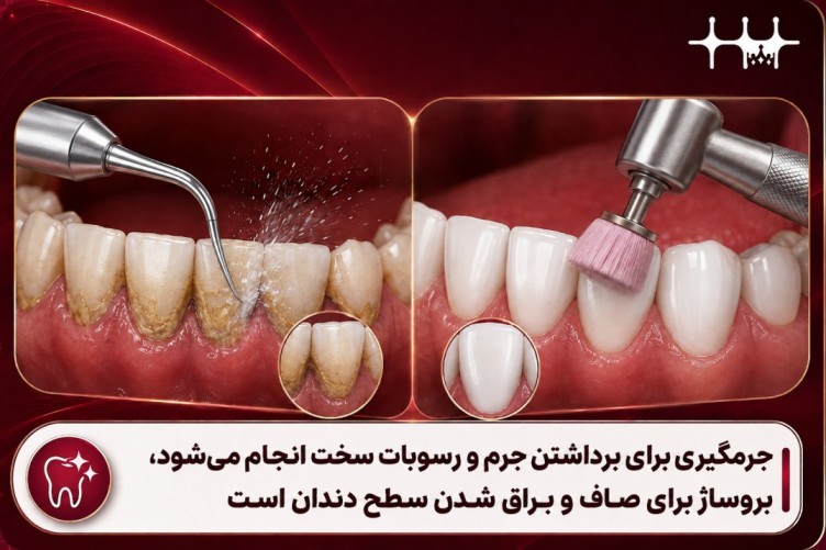 تقاوت جرمگیری با بروساژ دندان