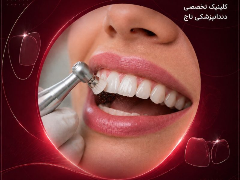 جرمگیری و بروساژ تخصصی دندان