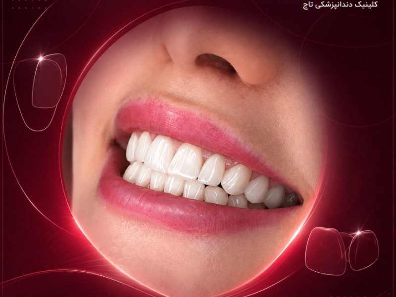 لمینت دندان