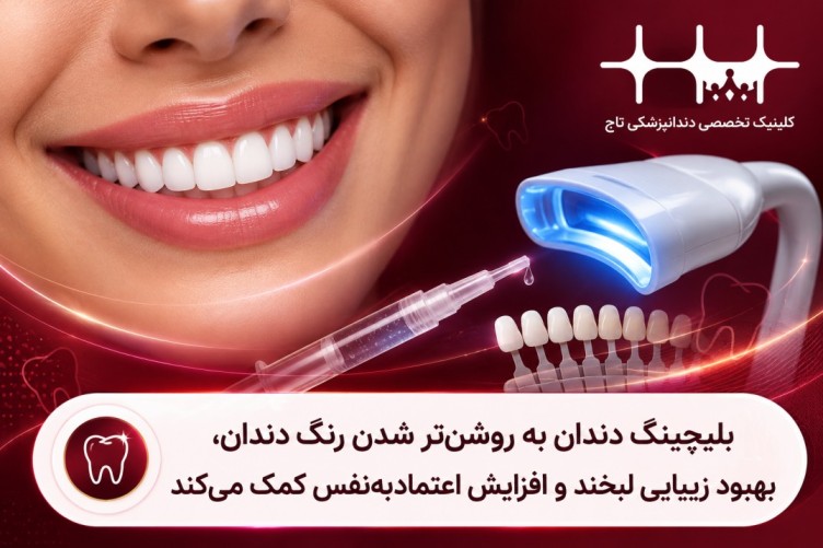 مزایای بلیچینگ دندان