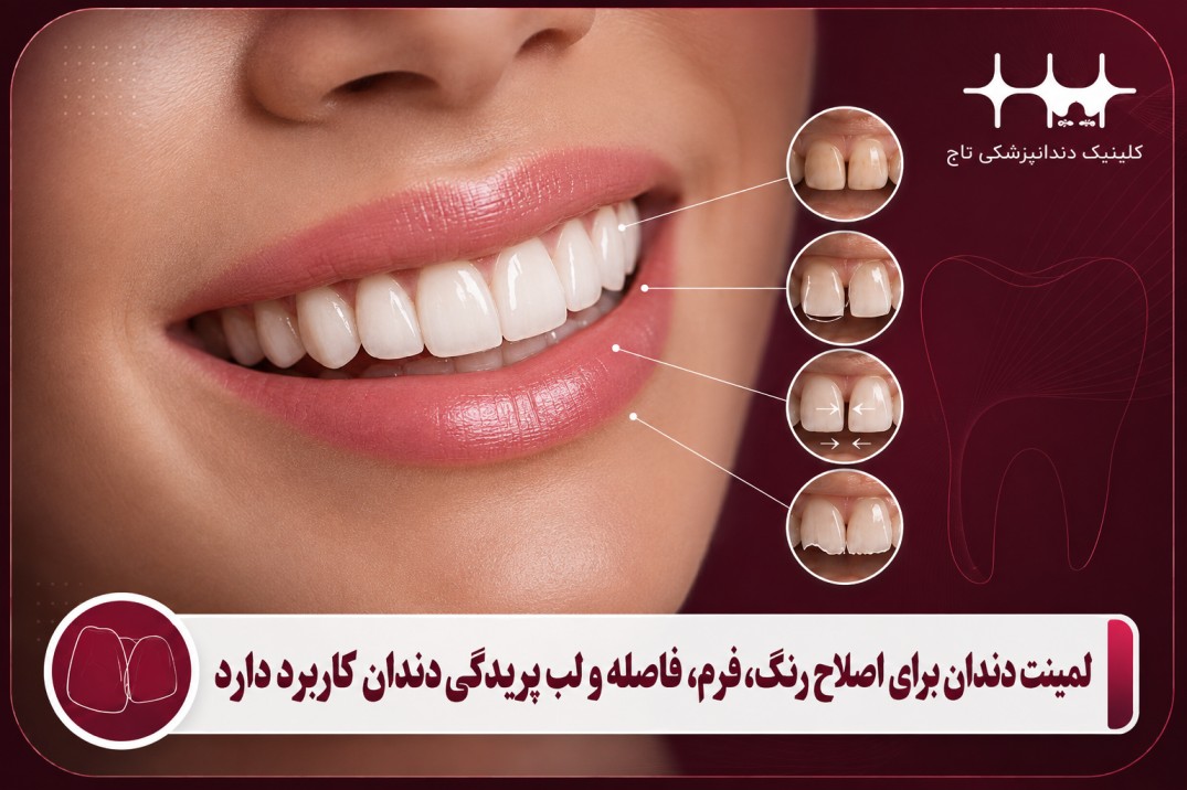 کاربردهای لمینت دندان