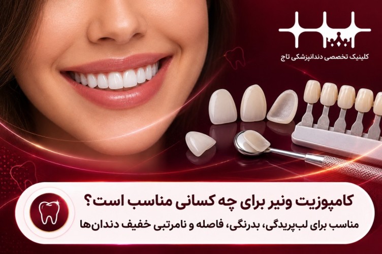 کامپوزیت ونیر برای چه کسانی مناسب است