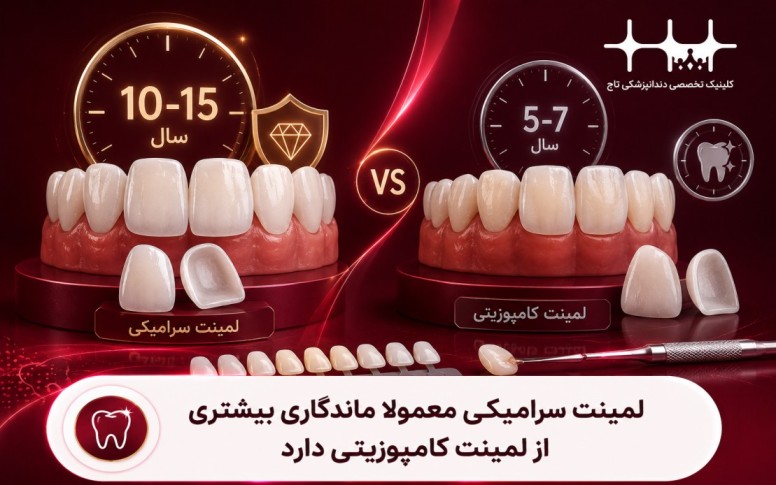 عمر لمینت سرامیکی در مقابل لمینت کامپوزیتی