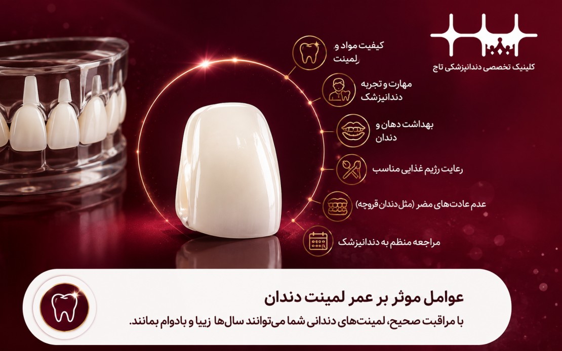 عوامل موثر بر عمر لمینت دندان